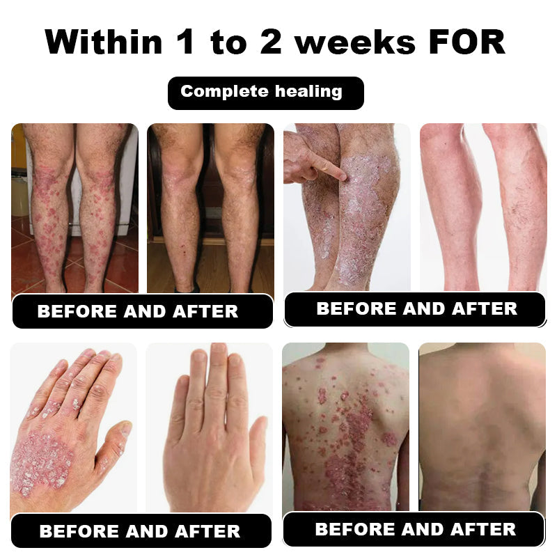 NESLEMY™ Psoriasis Cure Cream, relieves itching and restores smooth and youthful skin