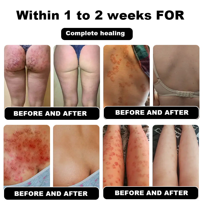 NESLEMY™ Psoriasis Cure Cream, relieves itching and restores smooth and youthful skin
