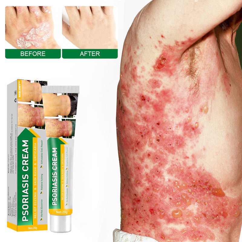 NESLEMY™ Psoriasis Cure Cream, relieves itching and restores smooth and youthful skin