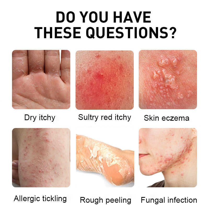 NESLEMY™ Psoriasis Cure Cream, relieves itching and restores smooth and youthful skin