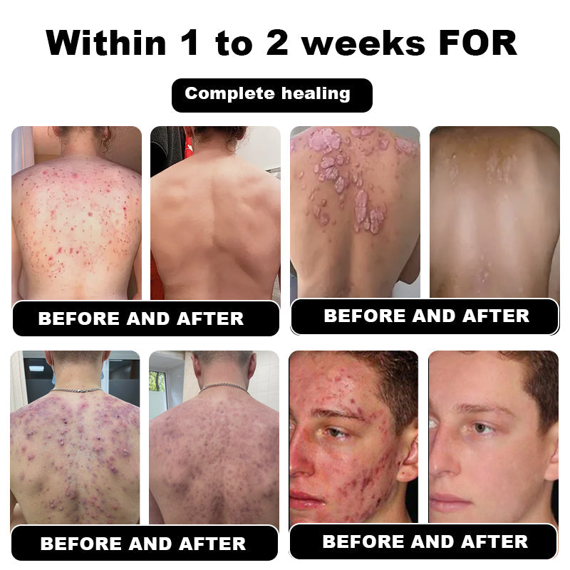 NESLEMY™ Psoriasis Cure Cream, relieves itching and restores smooth and youthful skin