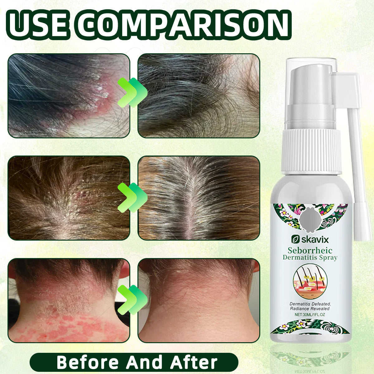 Skavix™Spray Derma – Soothing Relief for Redness & Flakes