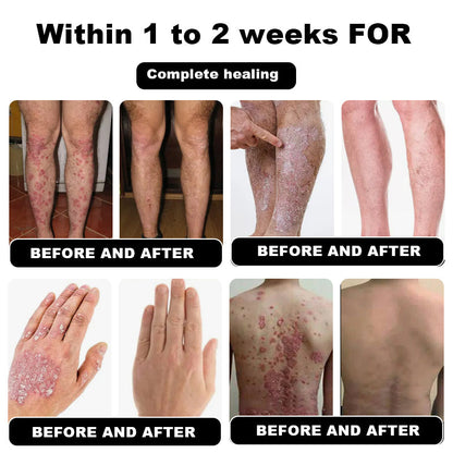 NESLEMY™ Psoriasis Cure Cream, relieves itching and restores smooth and youthful skin