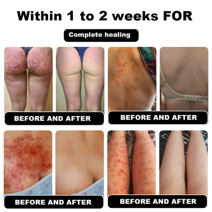 NESLEMY™ Psoriasis Cure Cream, relieves itching and restores smooth and youthful skin