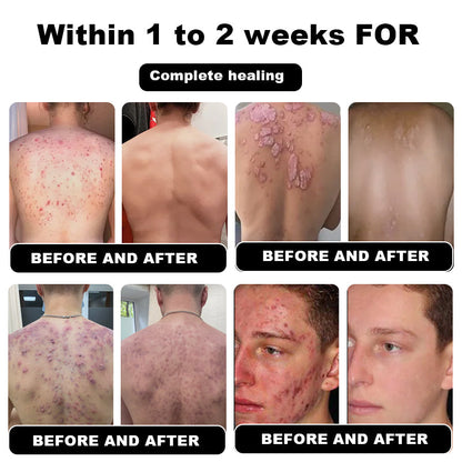 NESLEMY™ Psoriasis Cure Cream, relieves itching and restores smooth and youthful skin